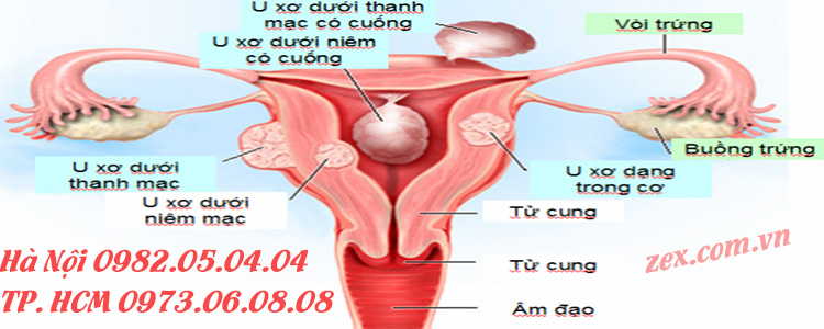 nguyên nhân vô sinh ở nữ giới