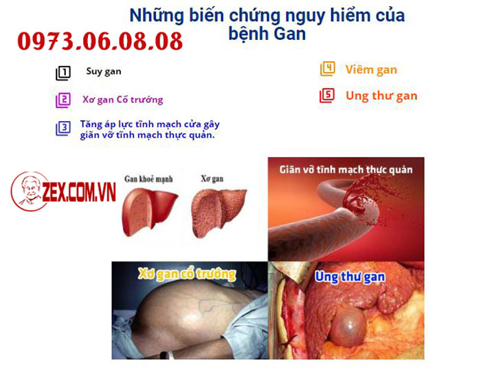 biến chứng viêm gan