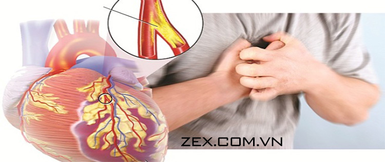 benh tim mach nguyen nhan gay ra roi loan cuong duong